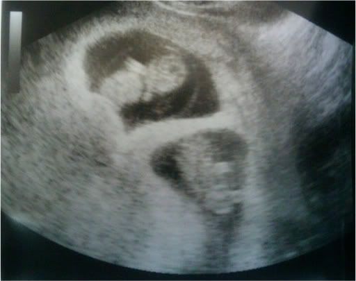 3d ultrasound pictures of twins. 3d ultrasound pictures at 12
