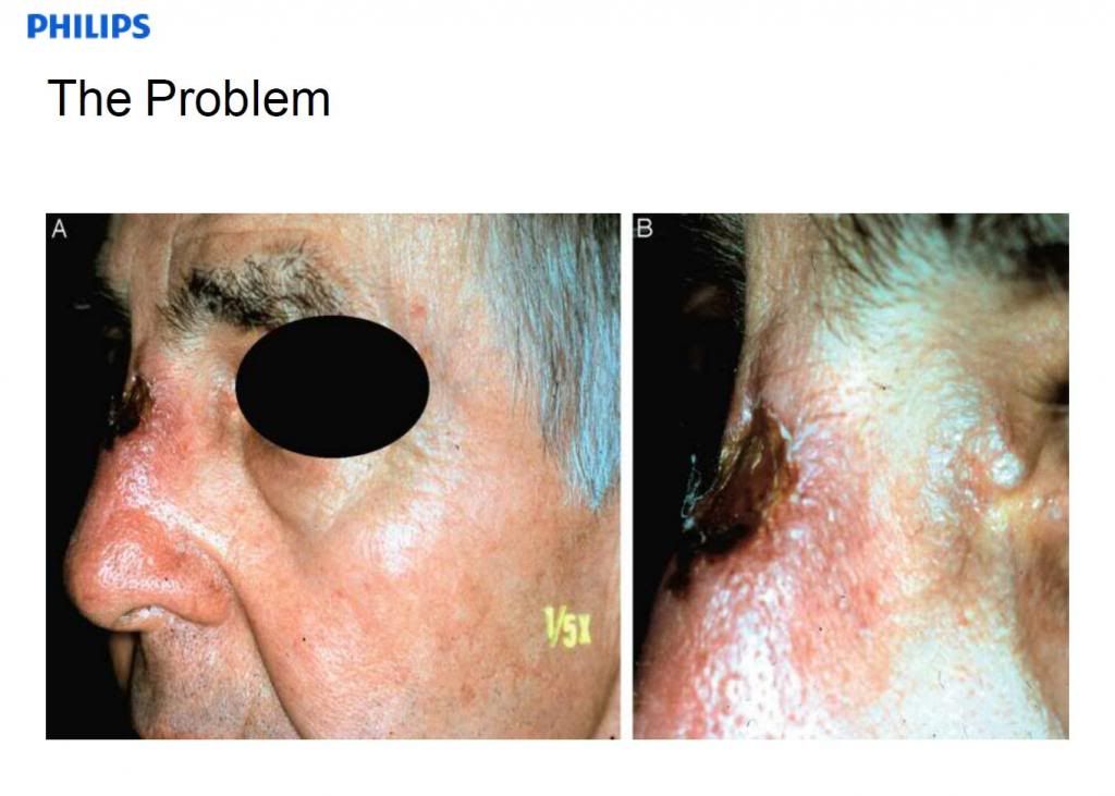 CPAP Basics 18 Complications of CPAP