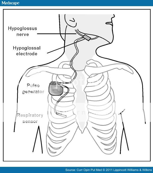 12 years on cpap and it's time to move on. - Page 12 - CPAPtalk.com